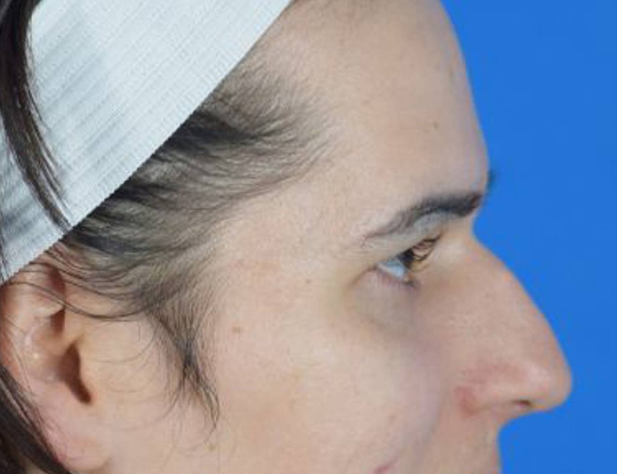 Rhinoplasty Before & After Image