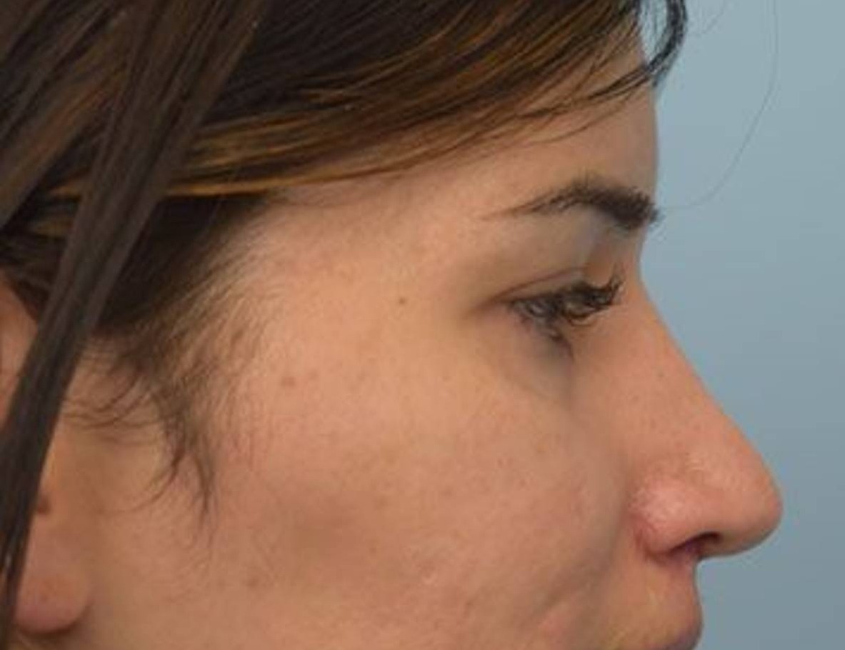 Rhinoplasty Before & After Image