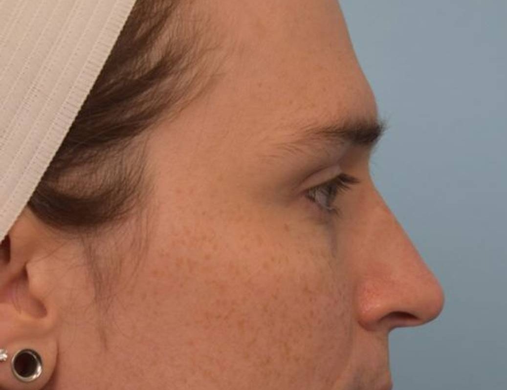 Rhinoplasty Before & After Image