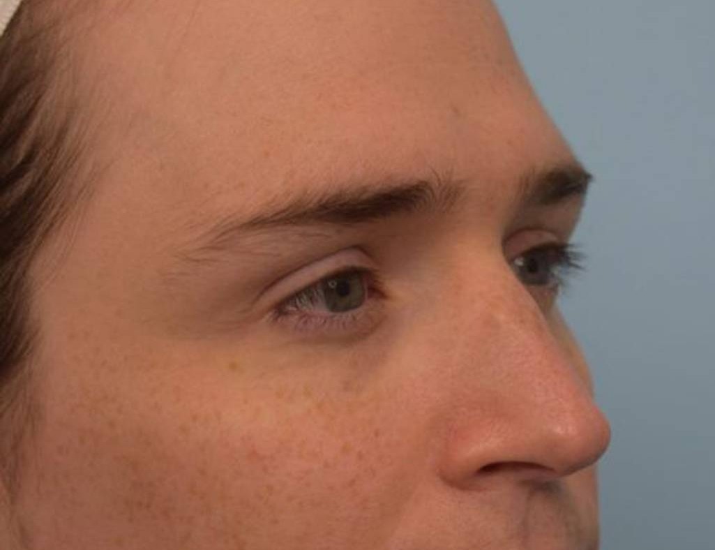 Rhinoplasty Before & After Image