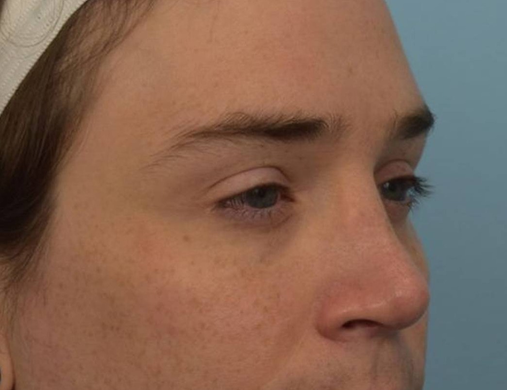 Rhinoplasty Before & After Image