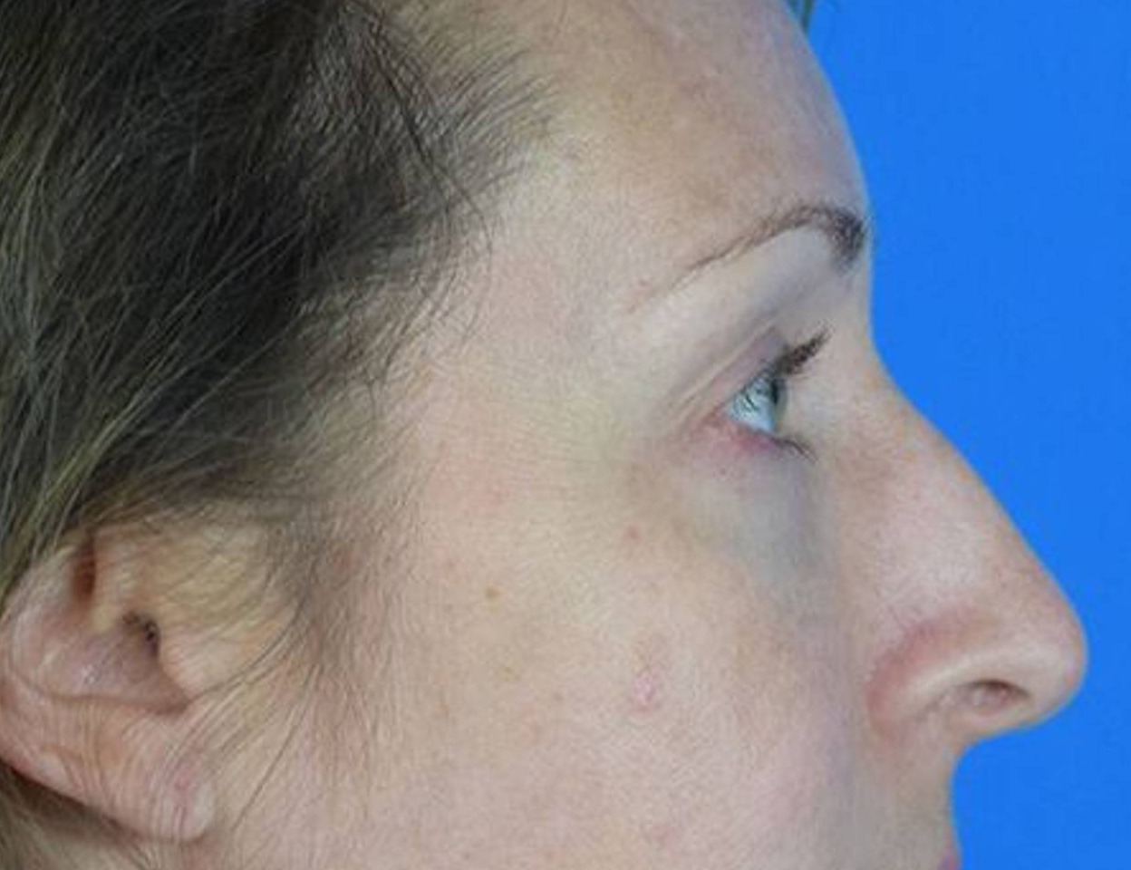 Rhinoplasty Before & After Image