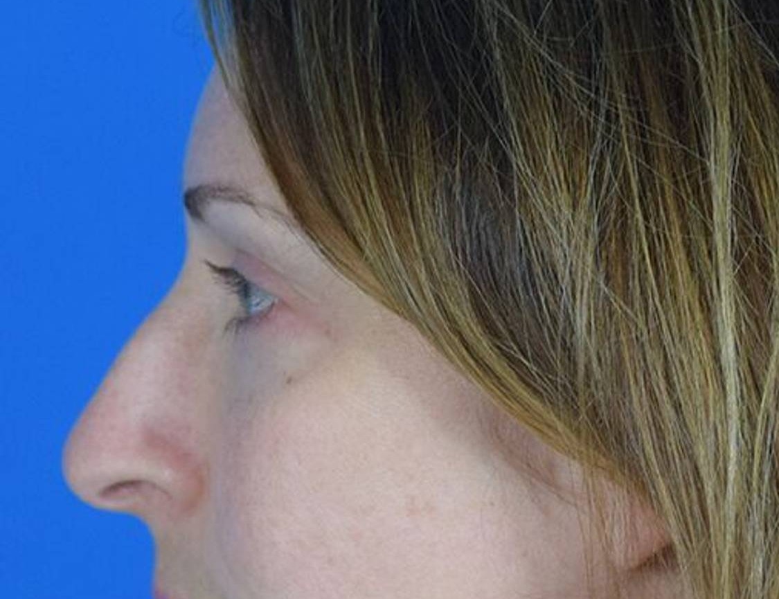 Rhinoplasty Before & After Image