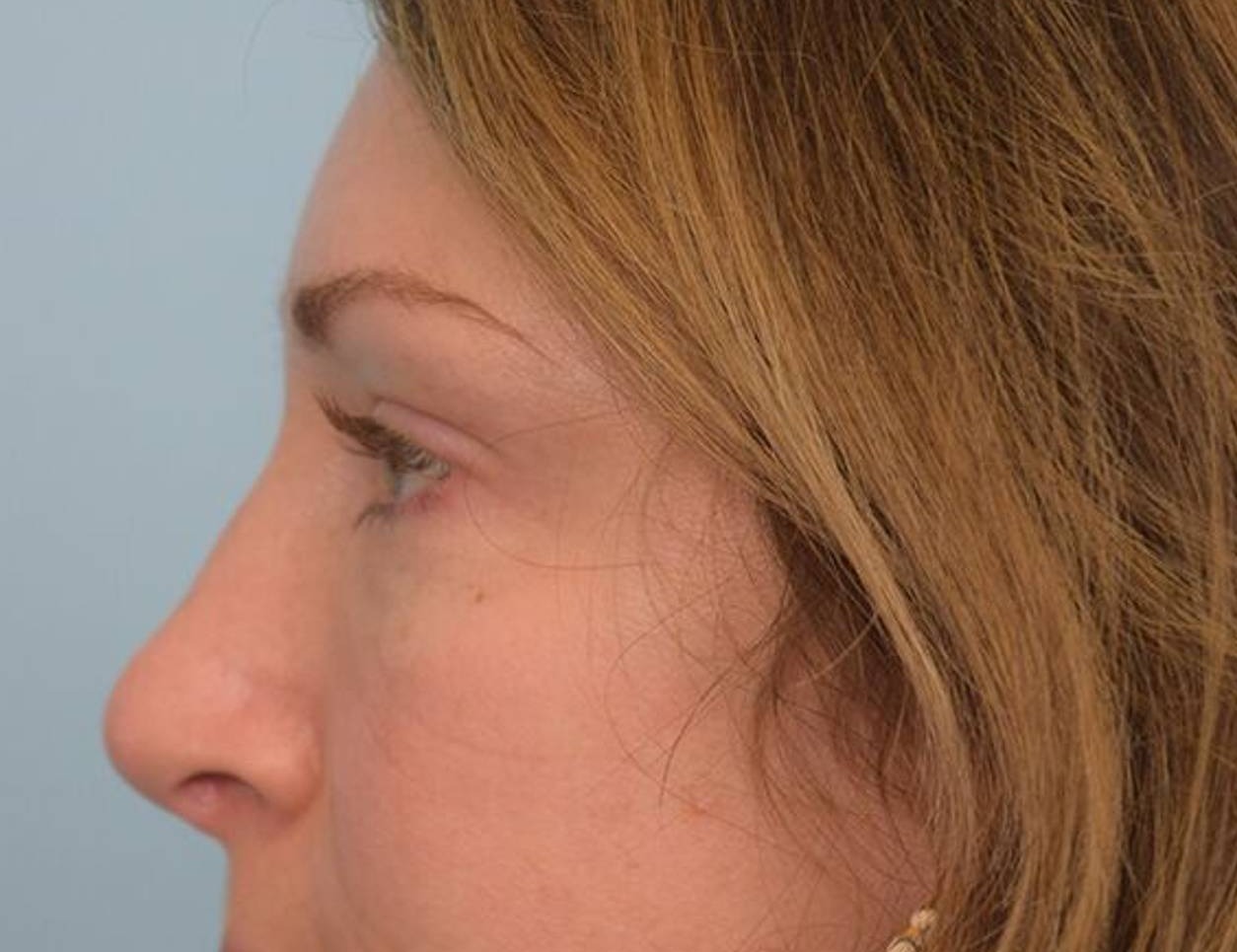 Rhinoplasty Before & After Image