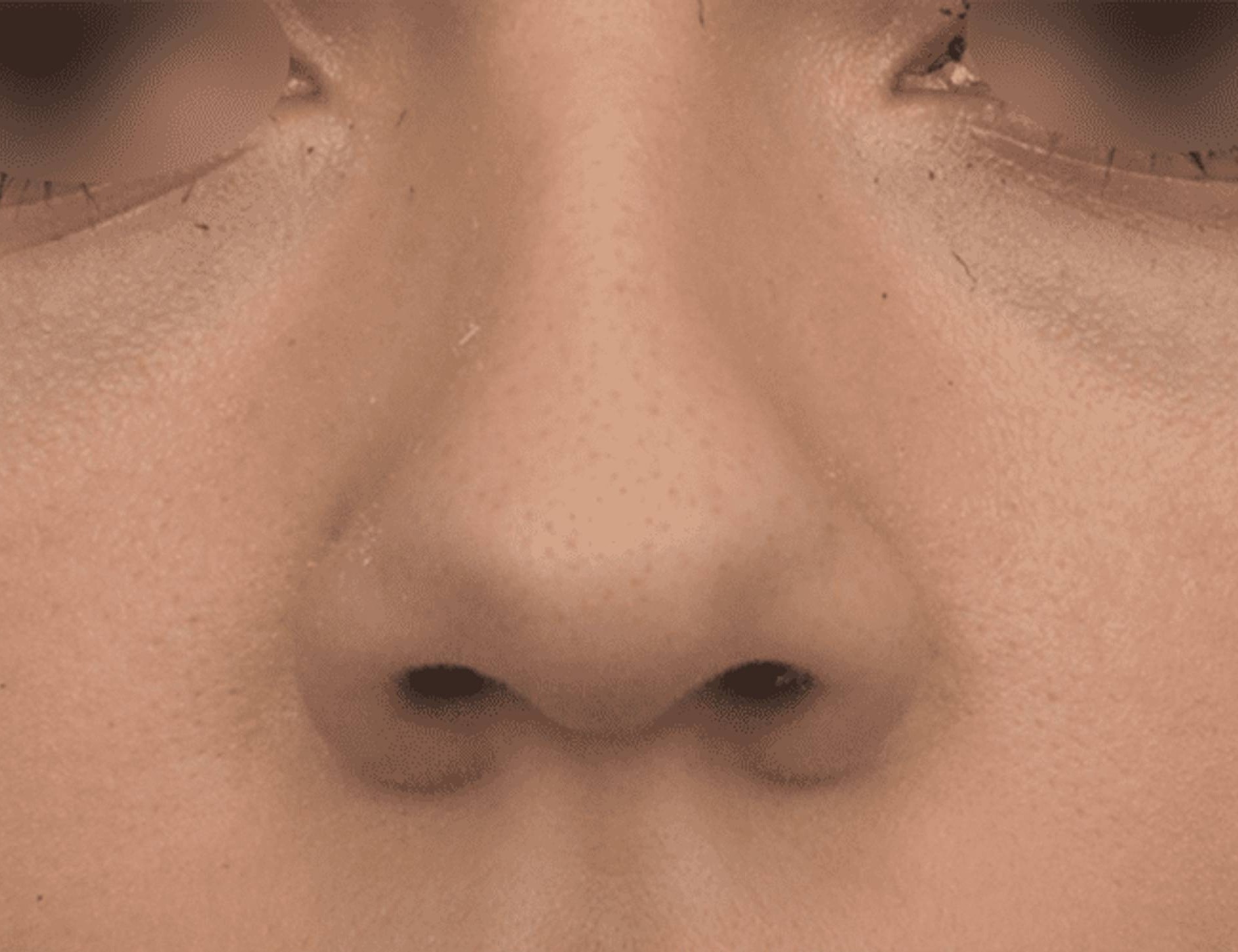 Rhinoplasty Before & After Image