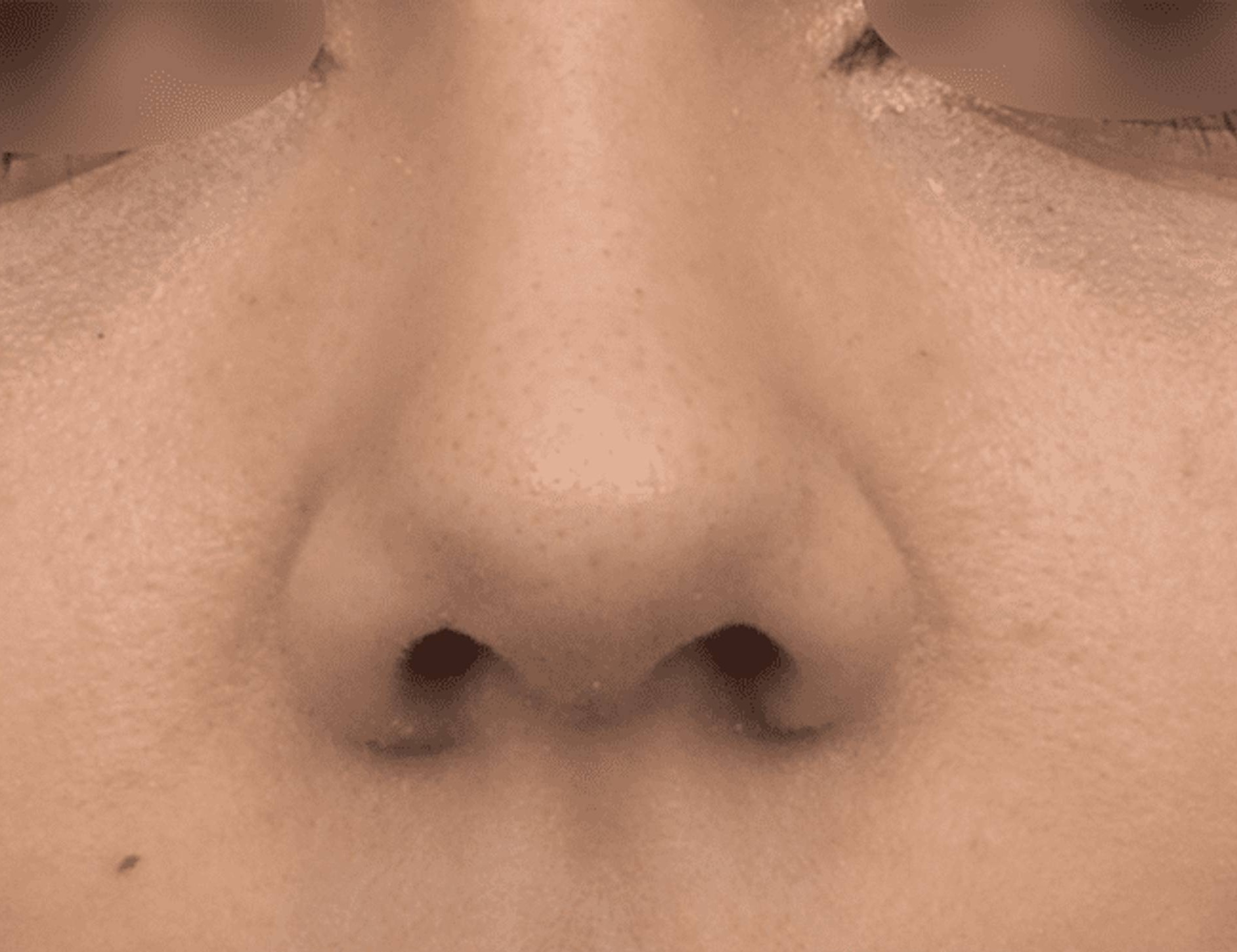 Rhinoplasty Before & After Image