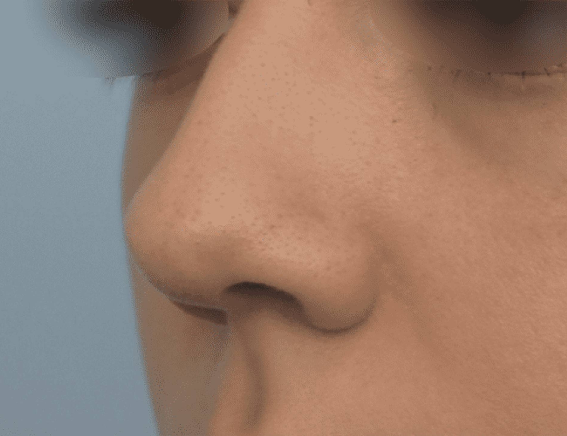 Rhinoplasty Before & After Image