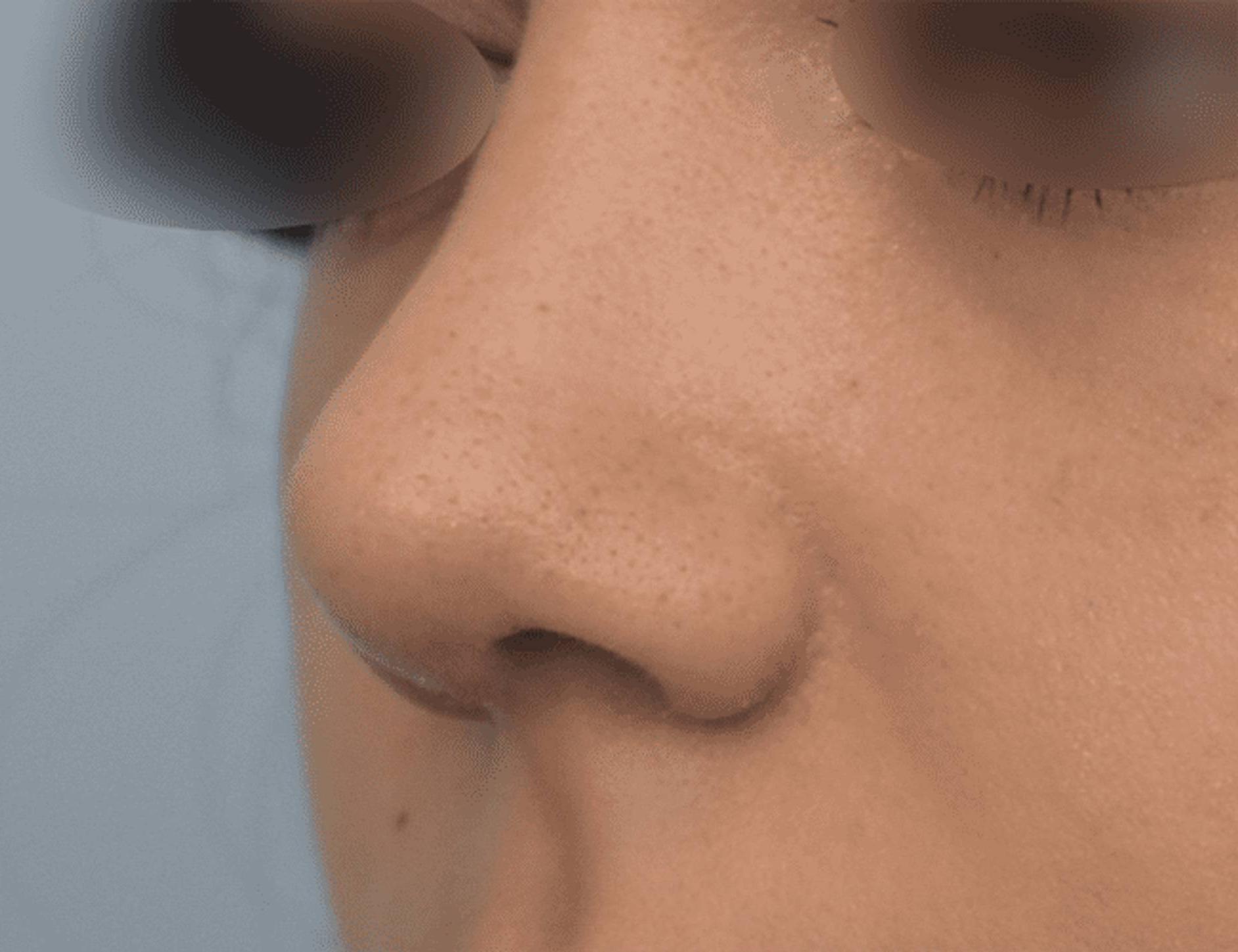 Rhinoplasty Before & After Image