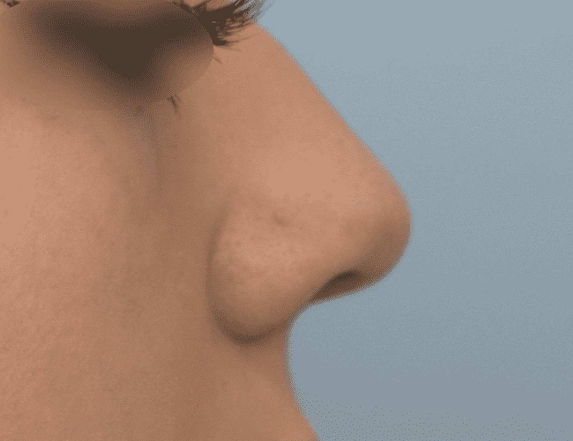 Rhinoplasty Before & After Image