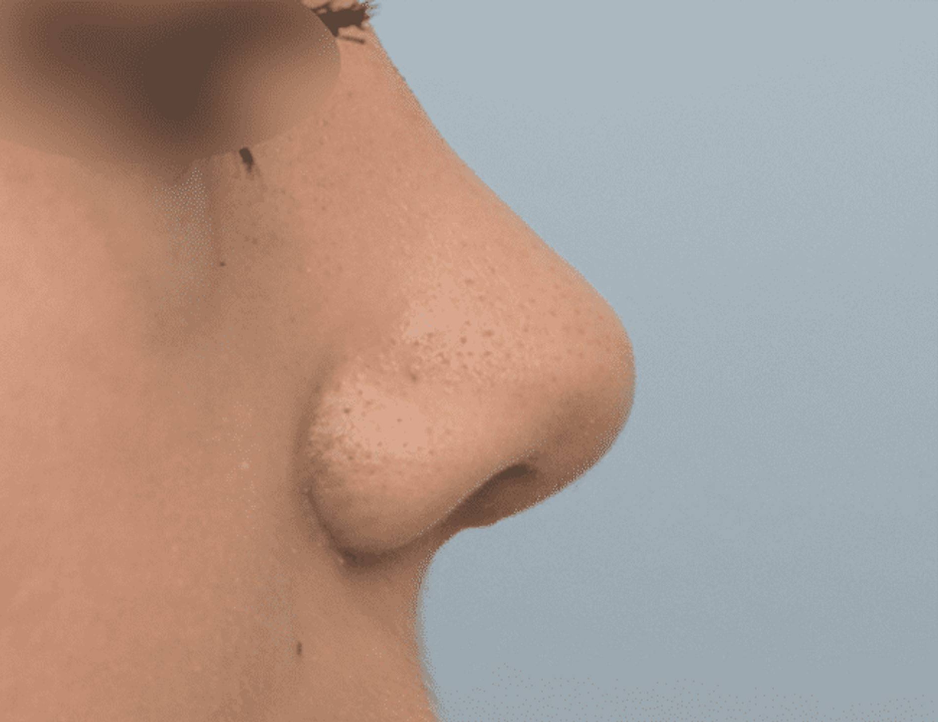 Rhinoplasty Before & After Image