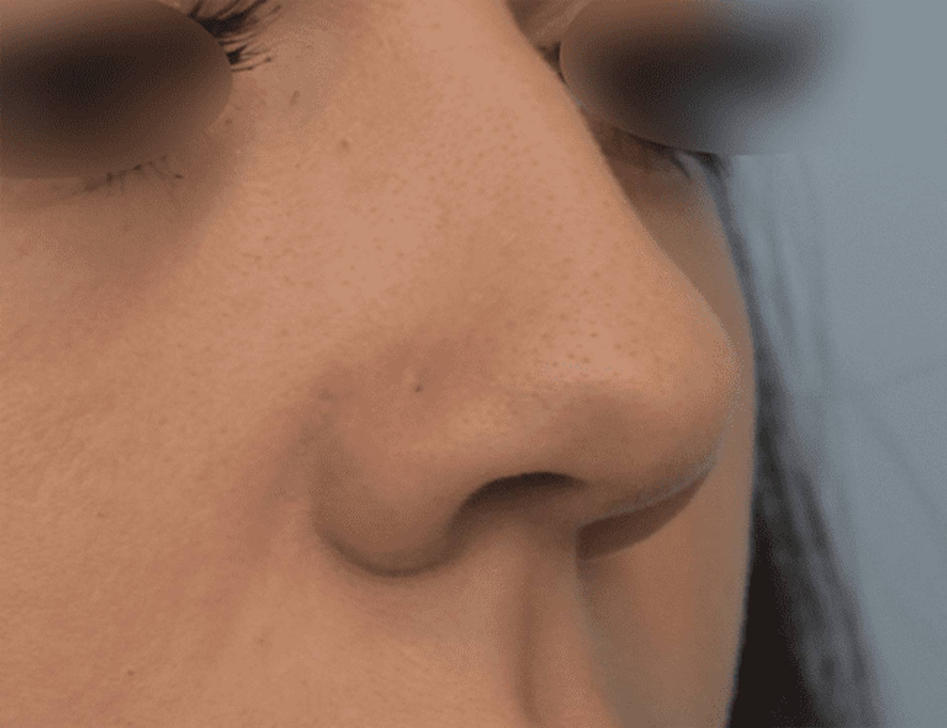 Rhinoplasty Before & After Image