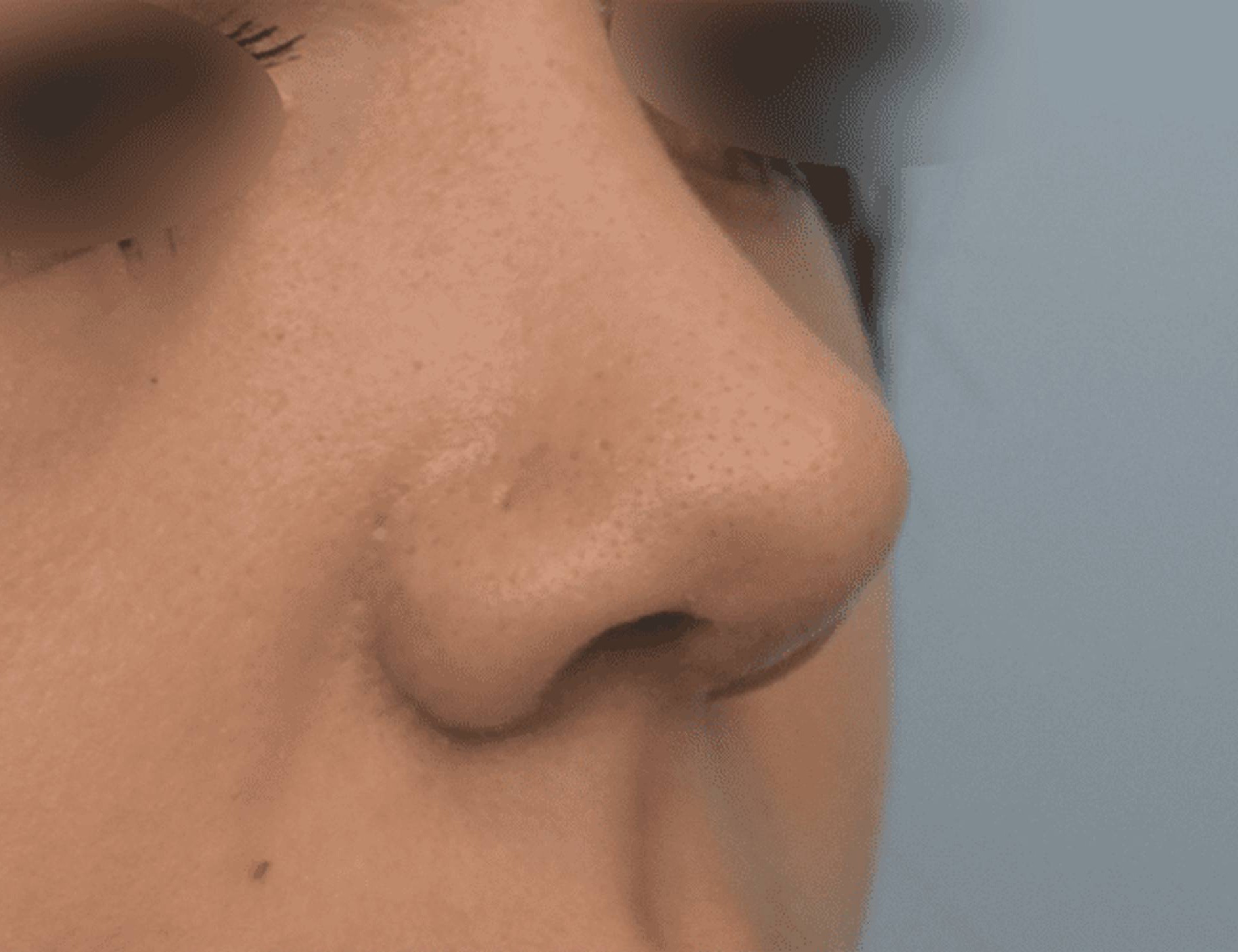 Rhinoplasty Before & After Image