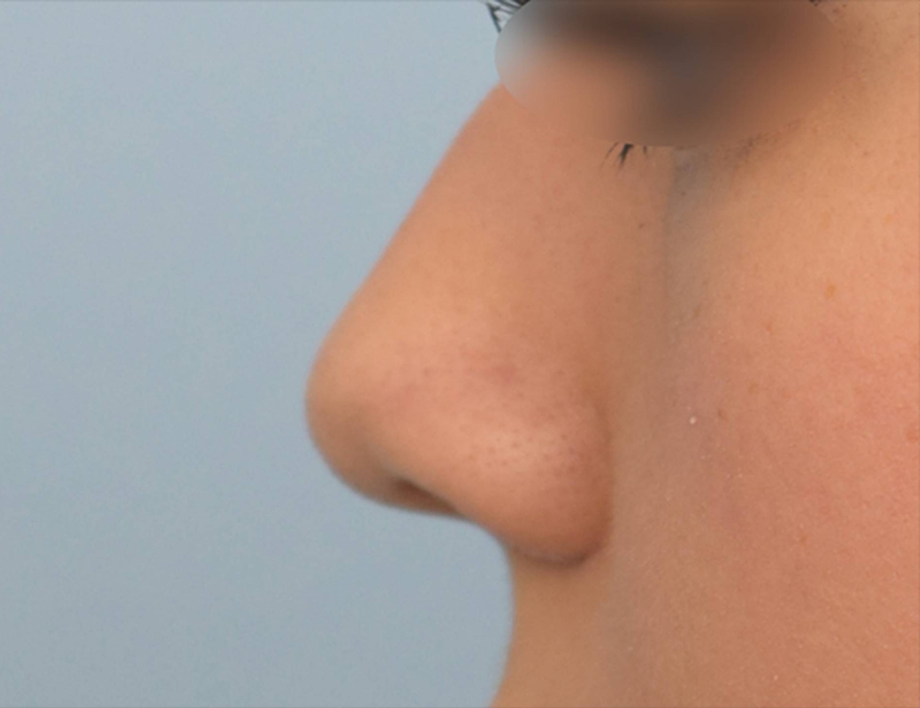 Rhinoplasty Before & After Image