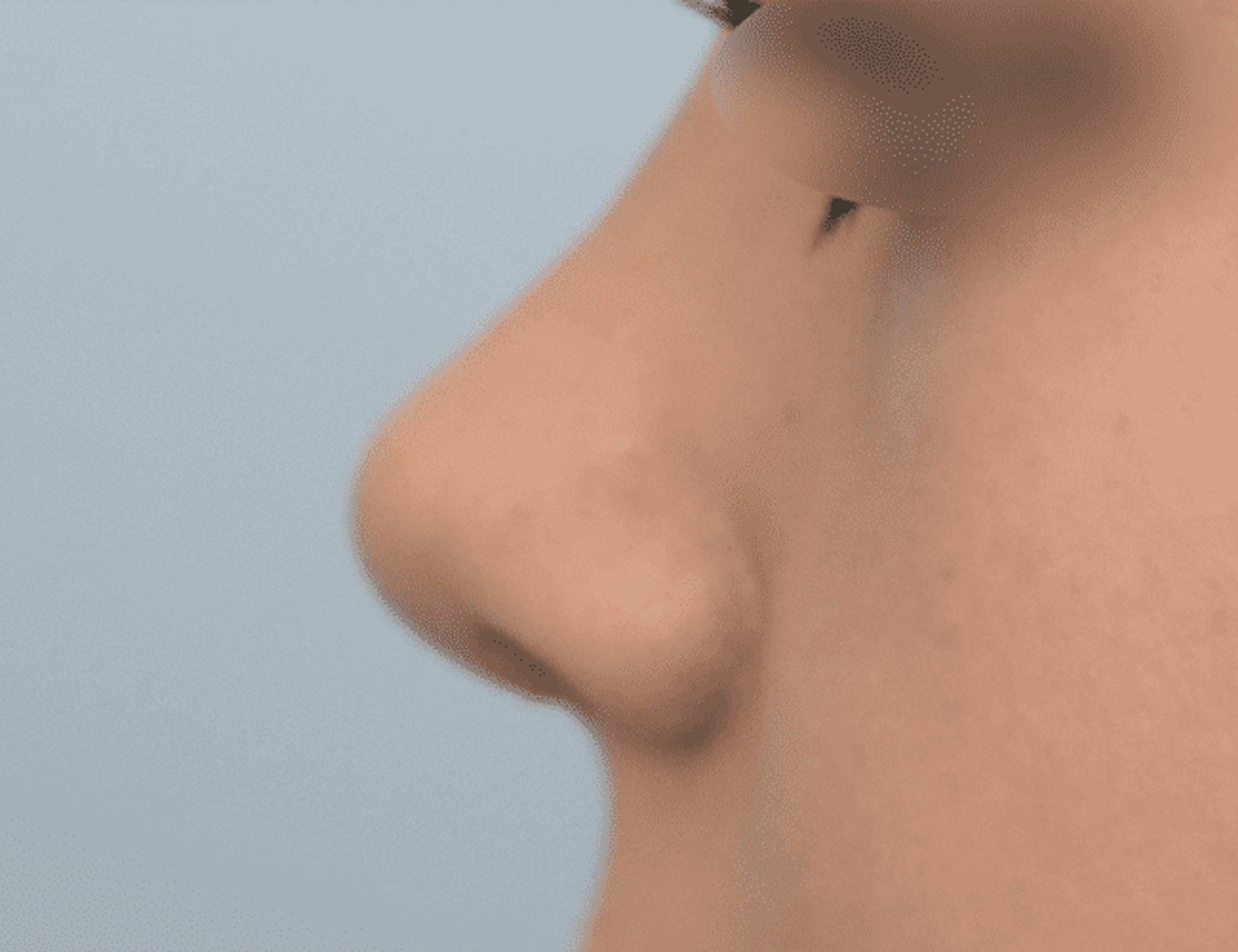 Rhinoplasty Before & After Image