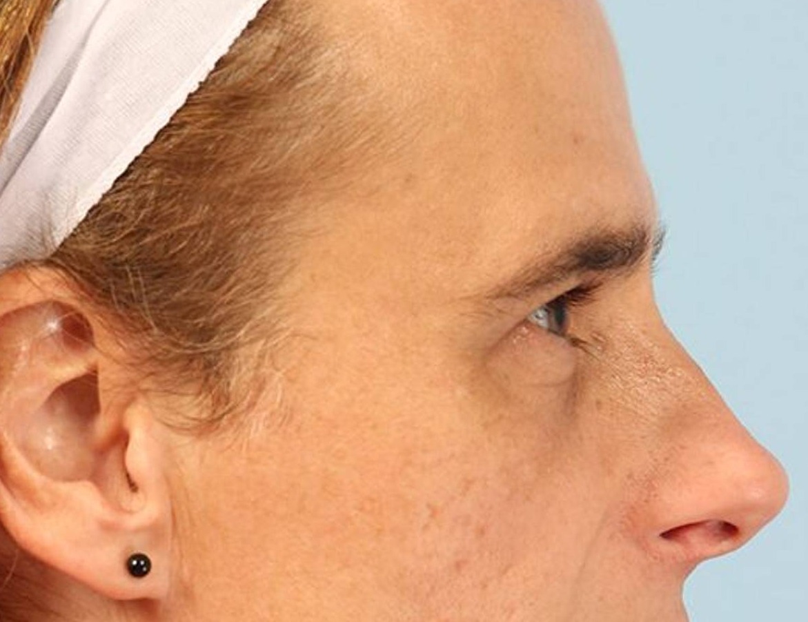 Rhinoplasty Before & After Image