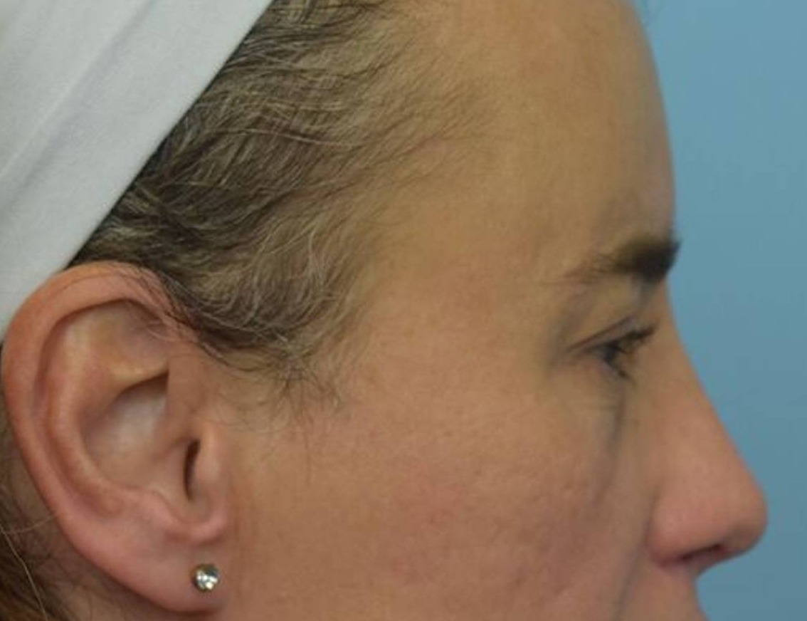 Rhinoplasty Before & After Image