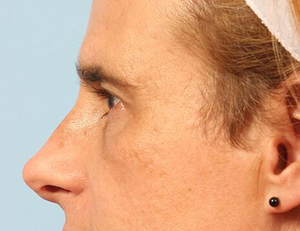 Rhinoplasty Before & After Image