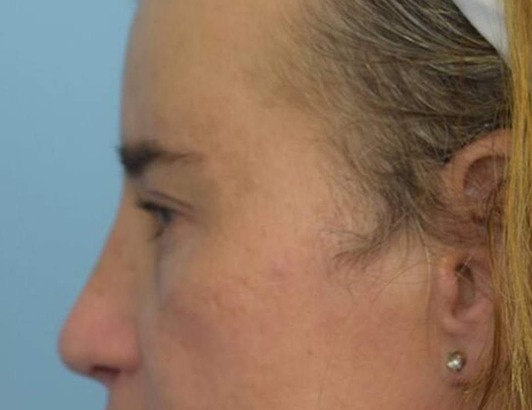 Rhinoplasty Before & After Image