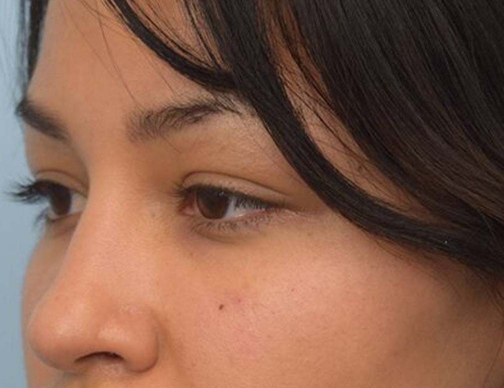 Rhinoplasty Before & After Image