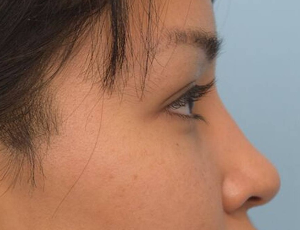 Rhinoplasty Before & After Image