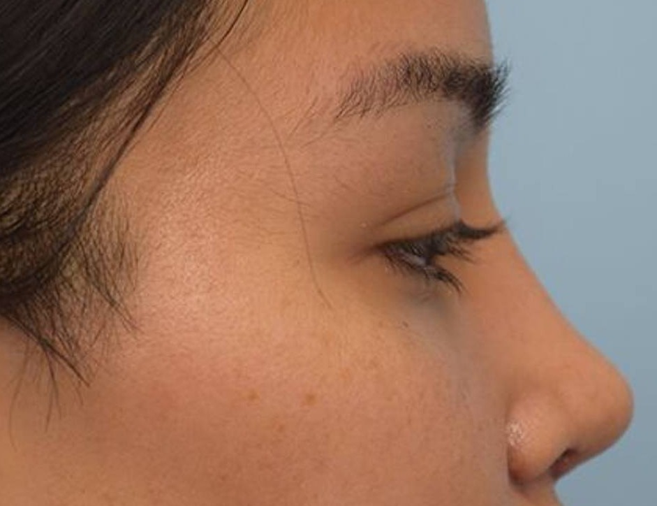 Rhinoplasty Before & After Image