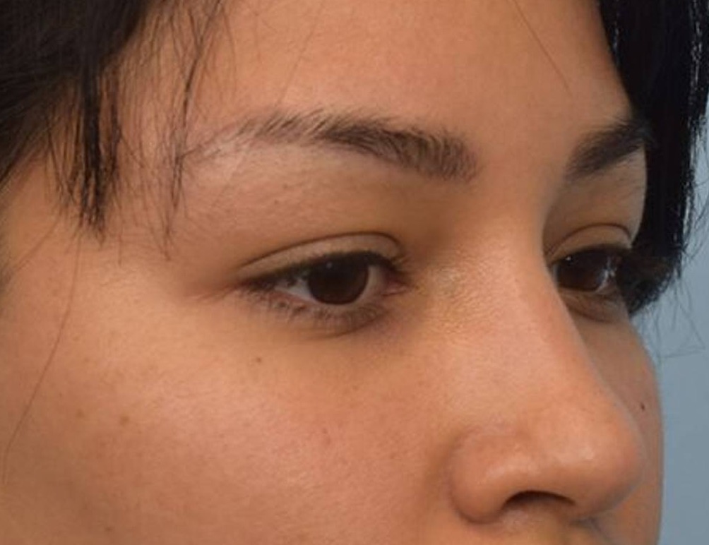 Rhinoplasty Before & After Image