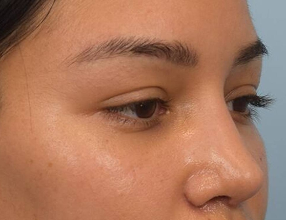 Rhinoplasty Before & After Image