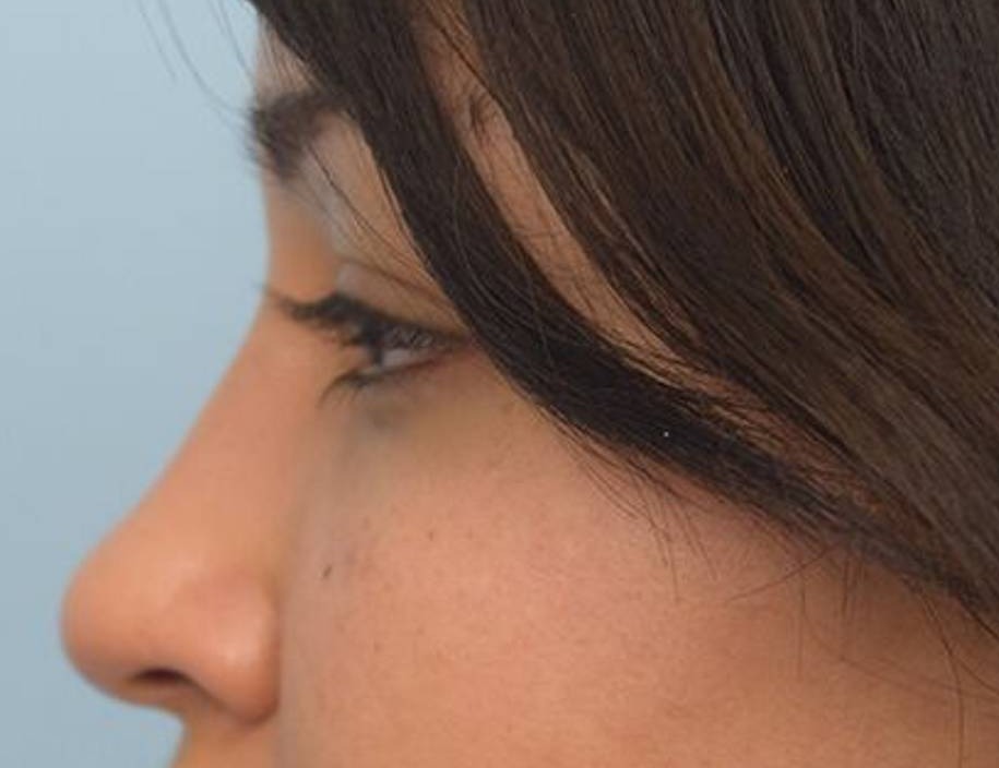 Rhinoplasty Before & After Image