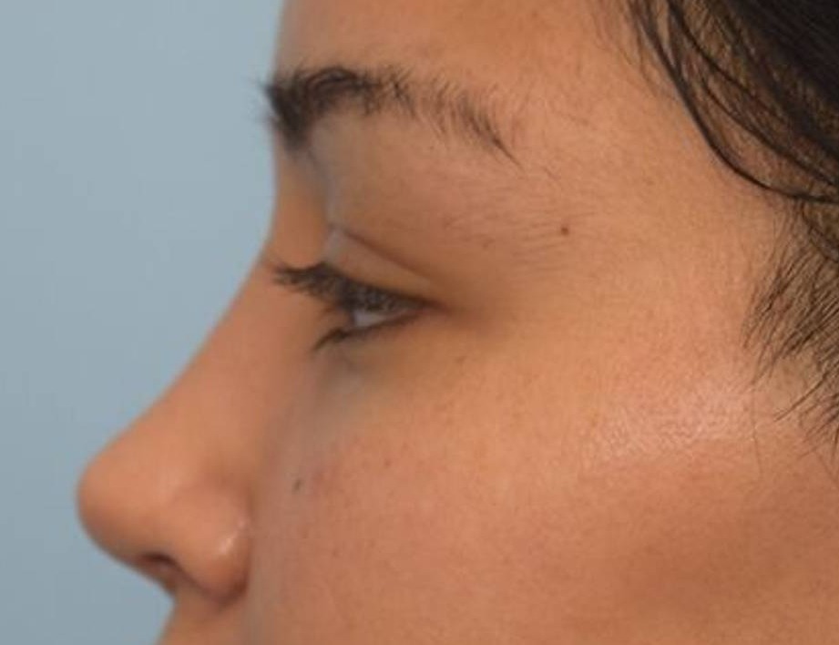 Rhinoplasty Before & After Image