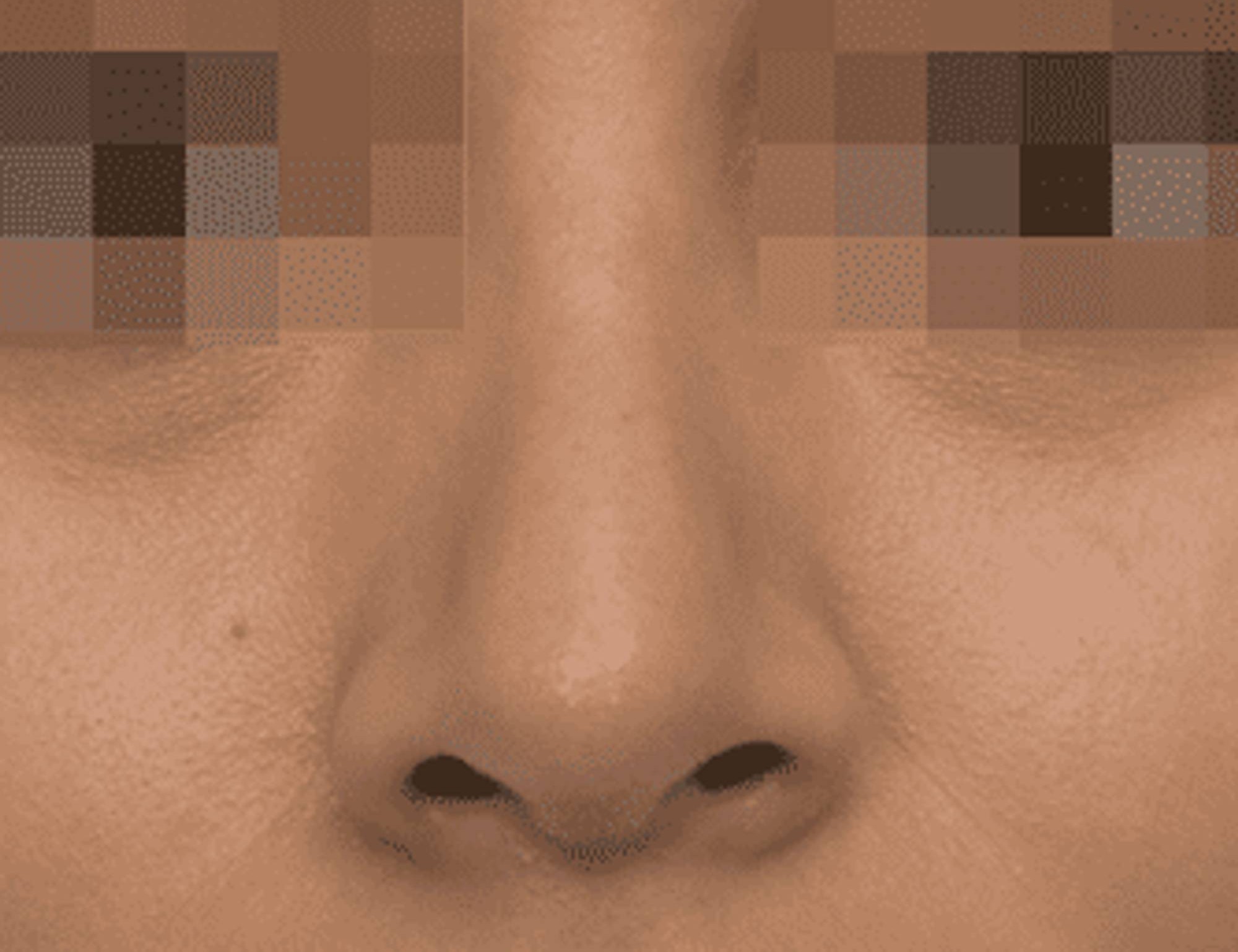 Rhinoplasty Before & After Image