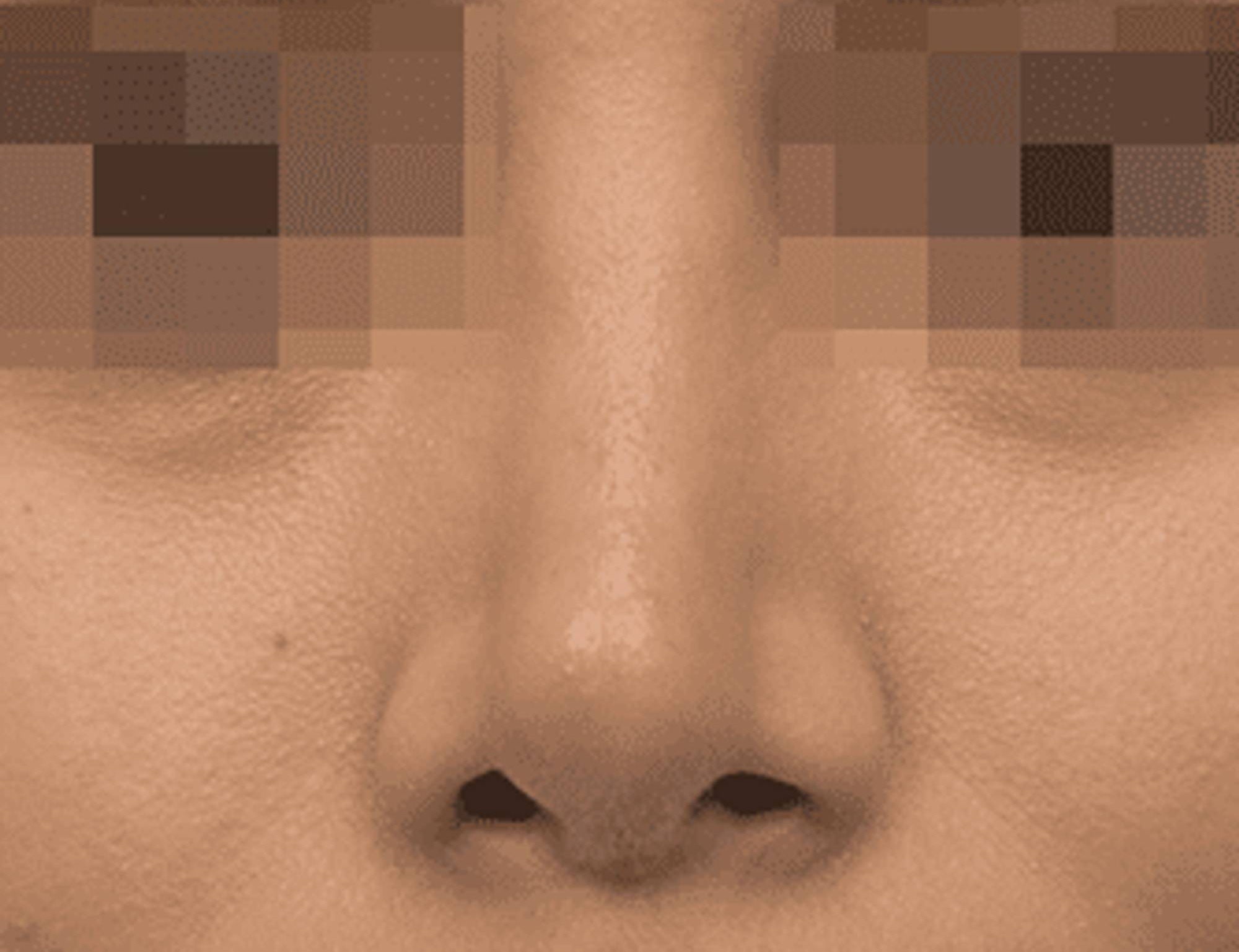 Rhinoplasty Before & After Image