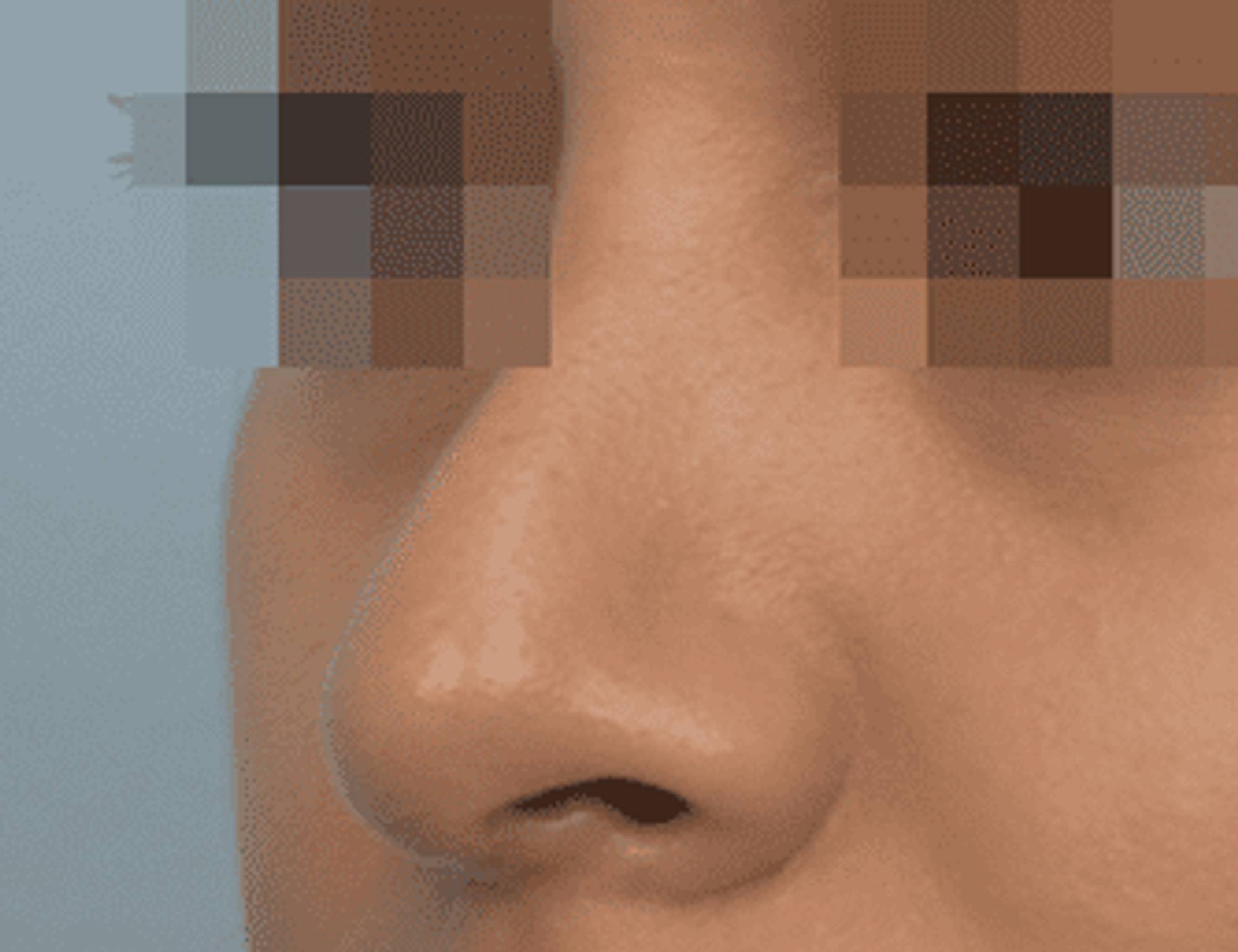 Rhinoplasty Before & After Image