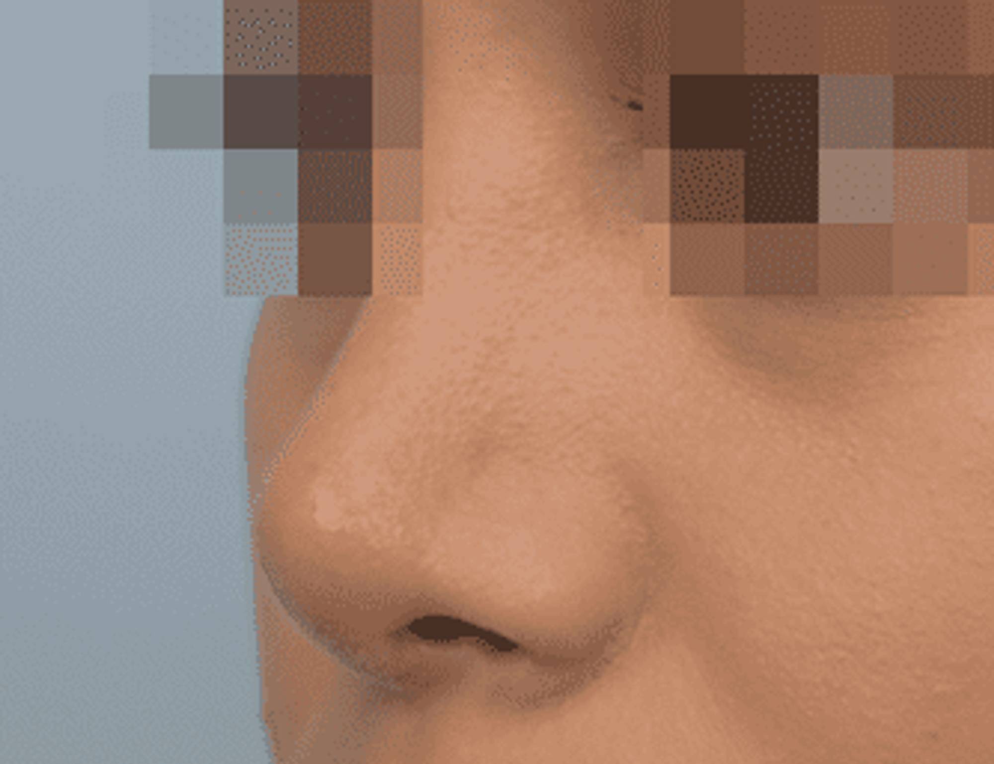 Rhinoplasty Before & After Image