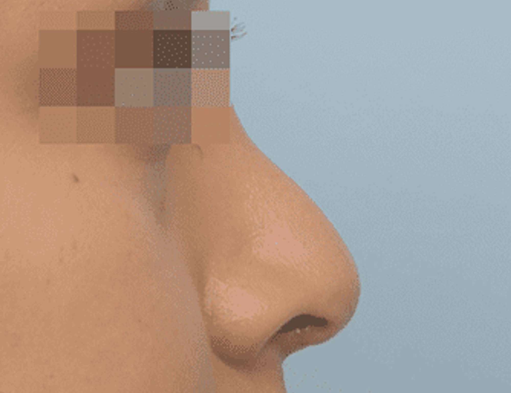 Rhinoplasty Before & After Image