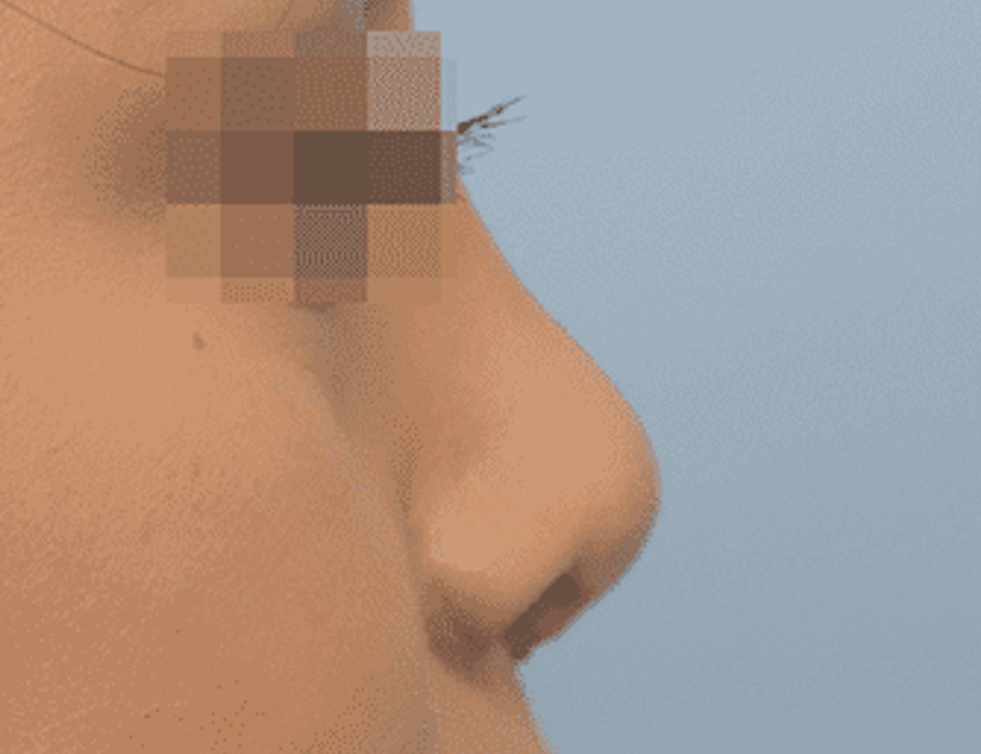 Rhinoplasty Before & After Image