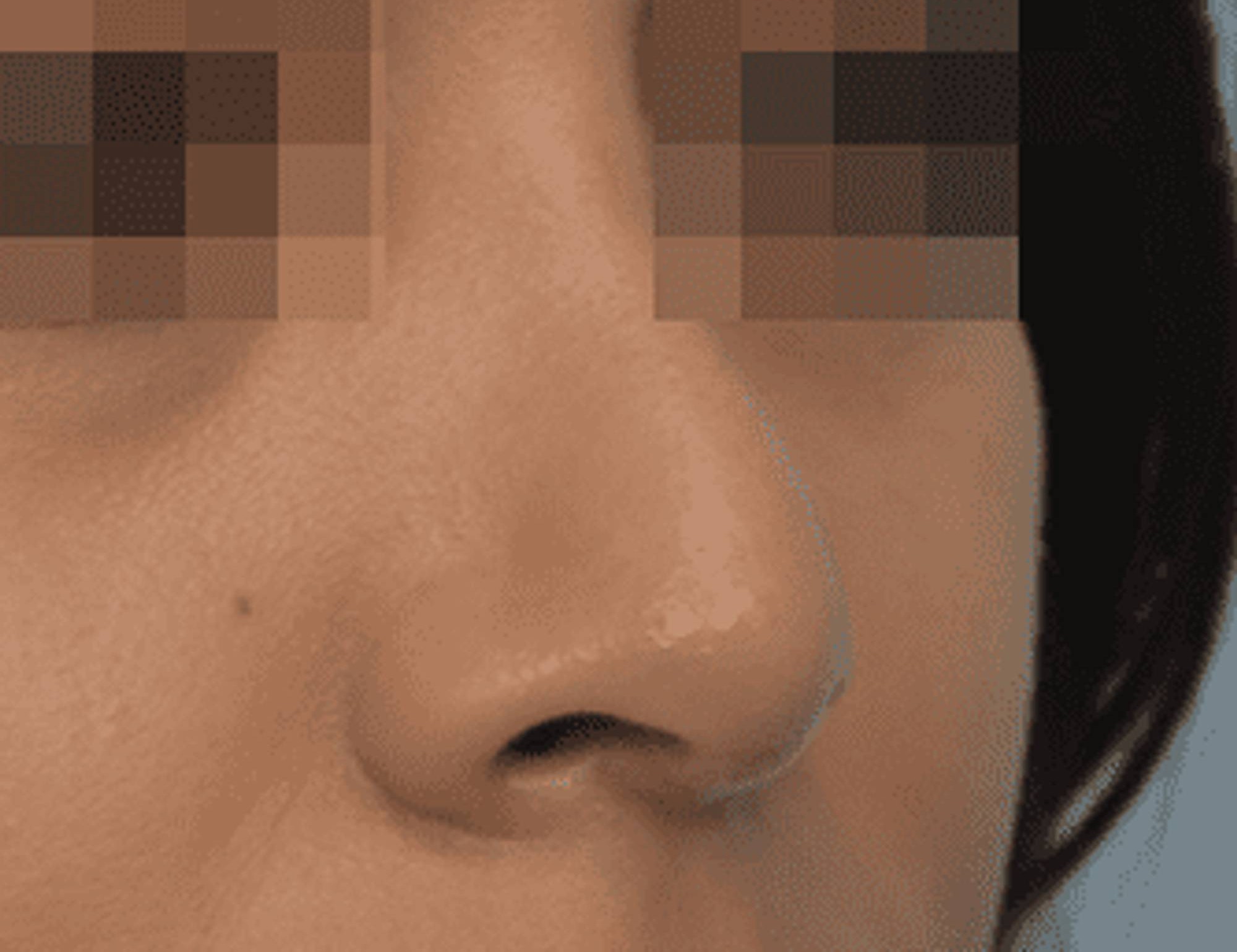 Rhinoplasty Before & After Image