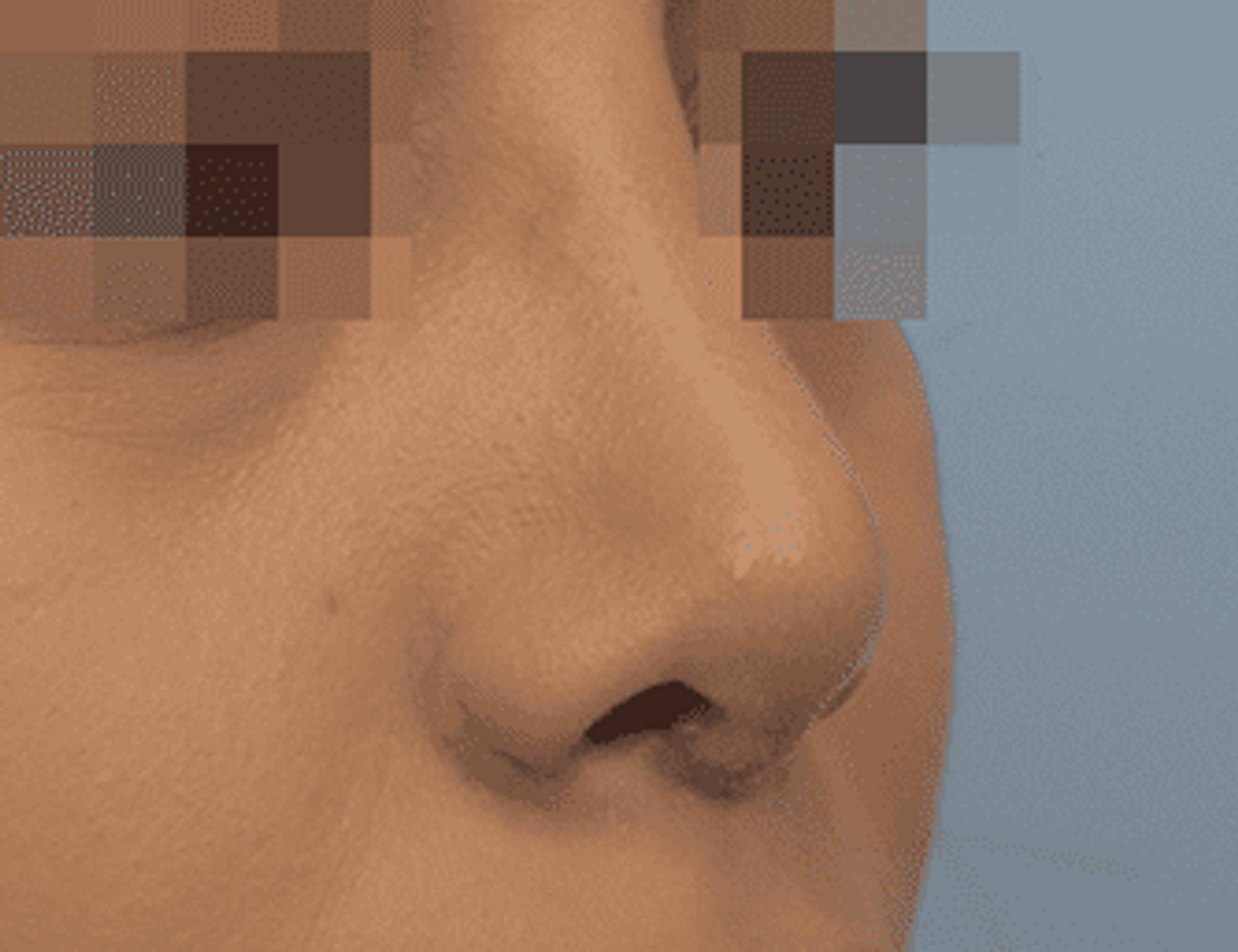 Rhinoplasty Before & After Image