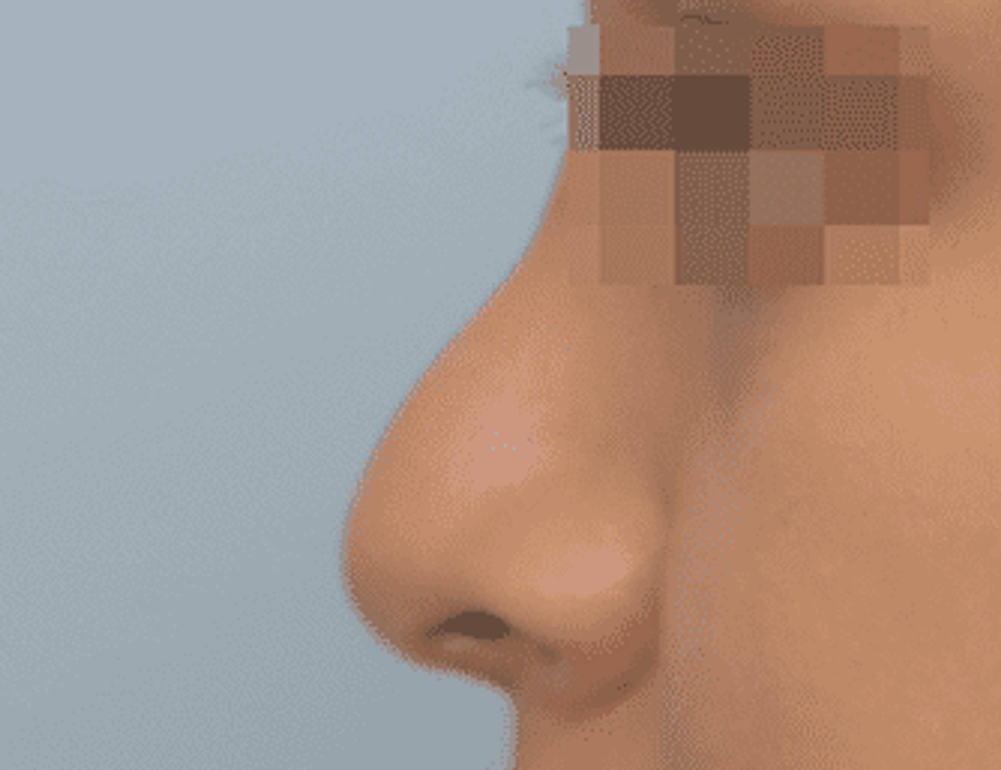 Rhinoplasty Before & After Image