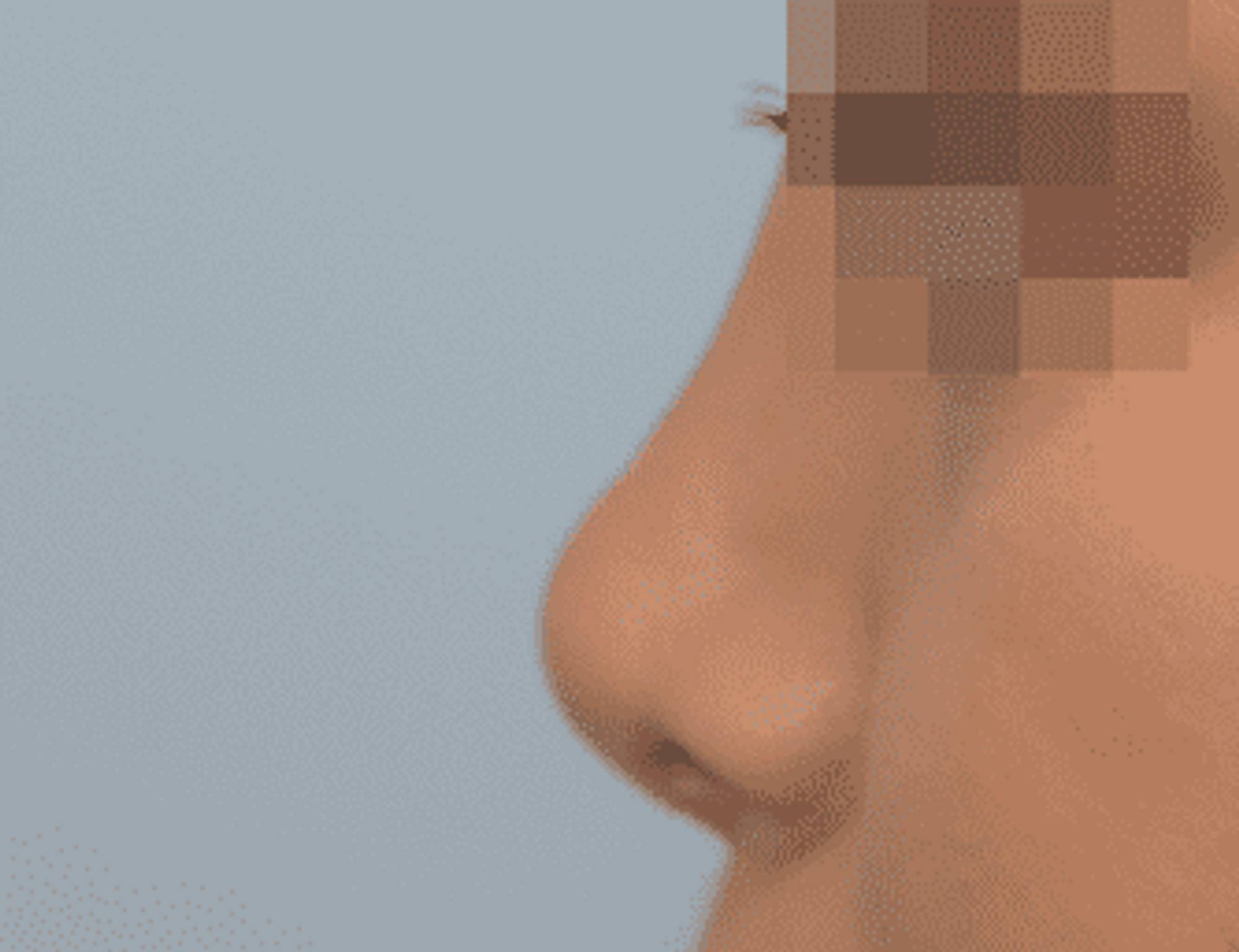 Rhinoplasty Before & After Image