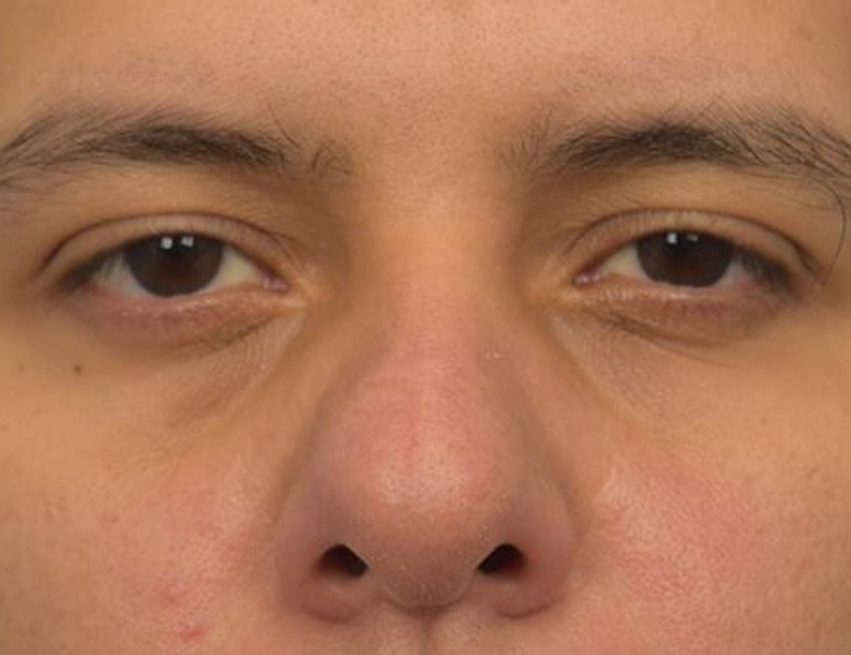 Rhinoplasty Before & After Image