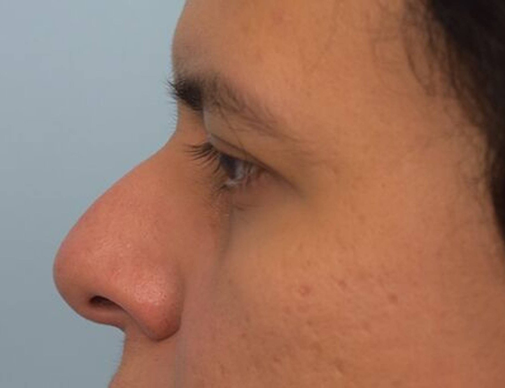 Rhinoplasty Before & After Image