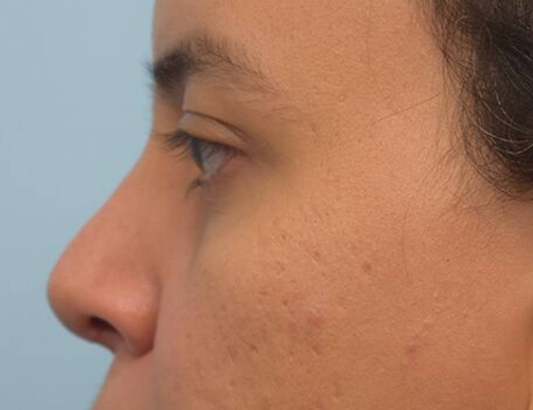 Rhinoplasty Before & After Image