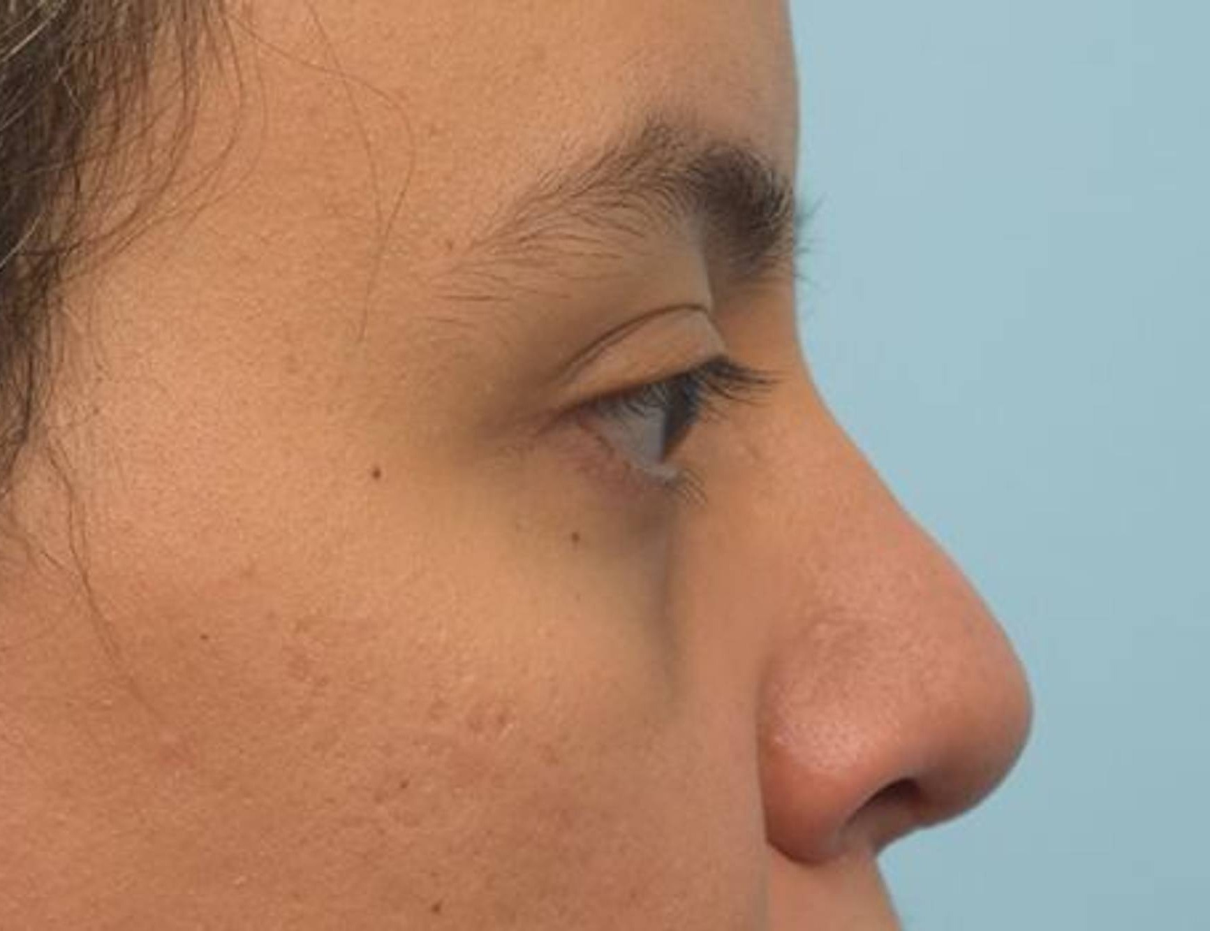 Rhinoplasty Before & After Image