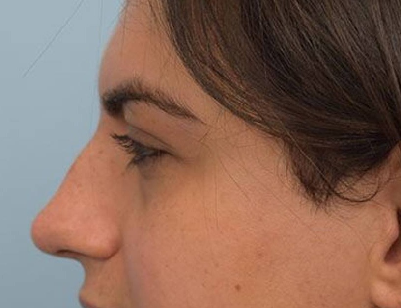 Rhinoplasty Before & After Image