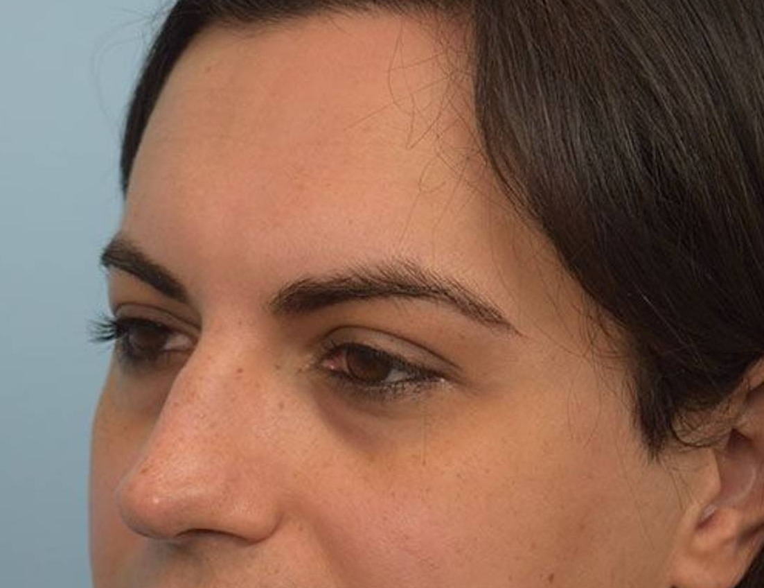 Rhinoplasty Before & After Image