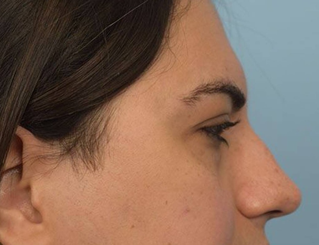 Rhinoplasty Before & After Image