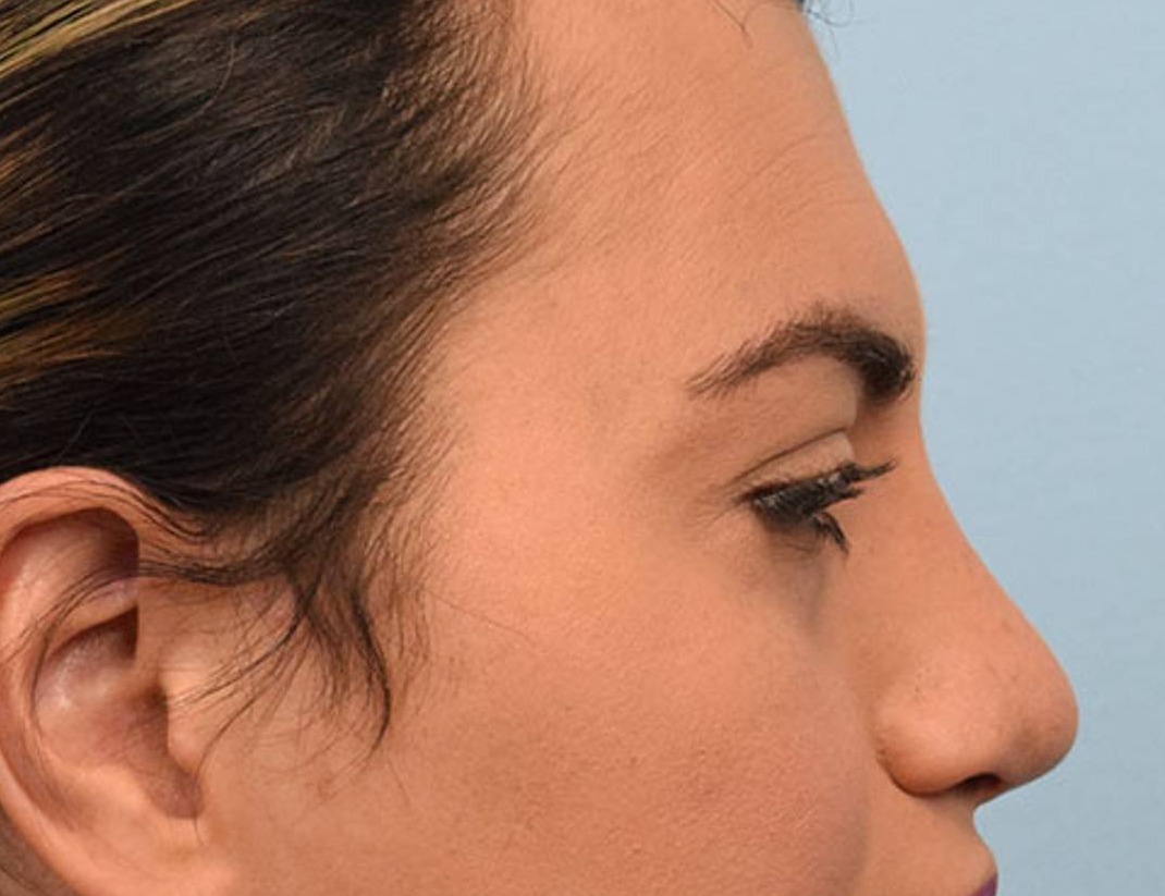 Rhinoplasty Before & After Image