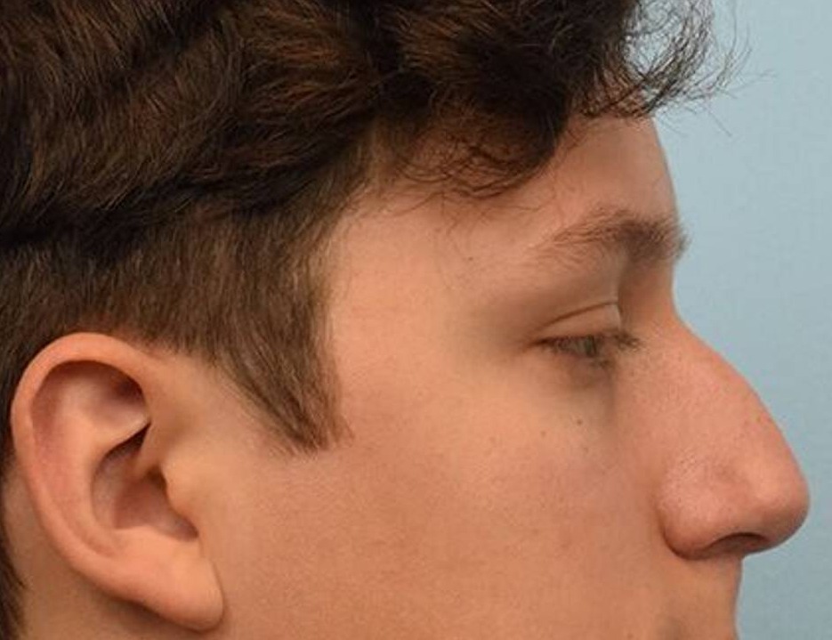 Rhinoplasty Before & After Image