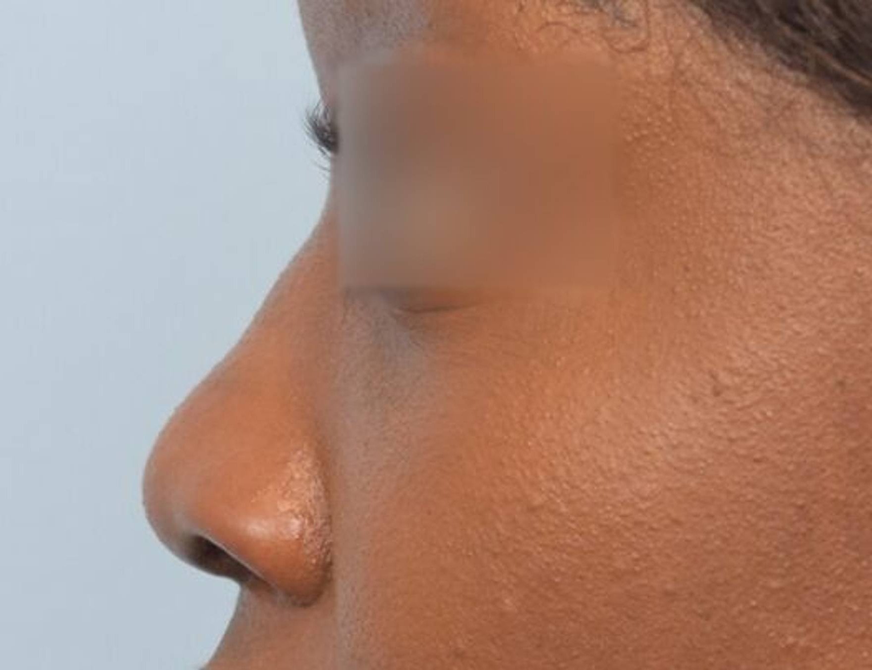 Rhinoplasty Before & After Image