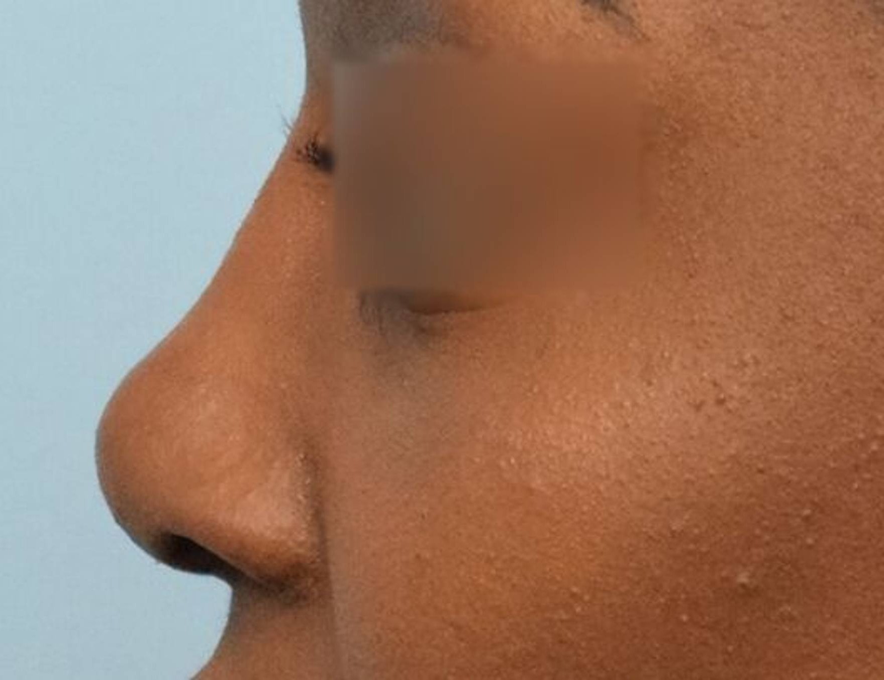 Rhinoplasty Before & After Image